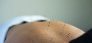 Elite Chiropractic and Wellness Centers offering acupuncture and chiropractic care in Franklin, Tennessee